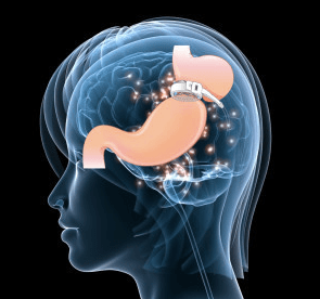 Anneau gastrique virtuel